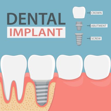 Infographics insan diş ve diş implantı. Düz grafik stili. Vektör çizim.