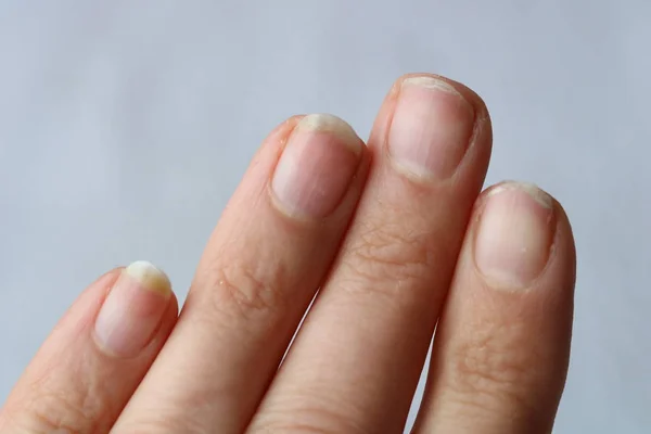 gombák nail osztályozás gomba a körmök kezében tünetek kezelése