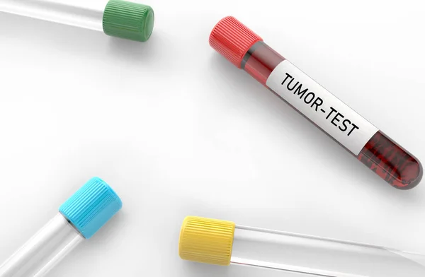 腫瘍検査結果血液検査試験管は 血液検査における患者における診断の腫瘍の概念を表に示す — ストック写真