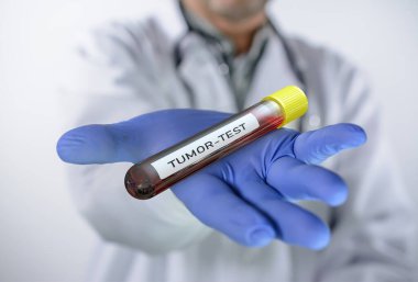 Doctor holds test tube with human blood for tumor test  clipart