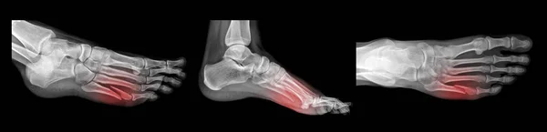 Ray Broken Human Foot View Views Settings Stock Picture