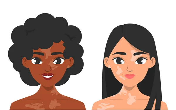Mulheres com vetor vitiligo isolado. Pigmentação da pele —  Vetores de Stock