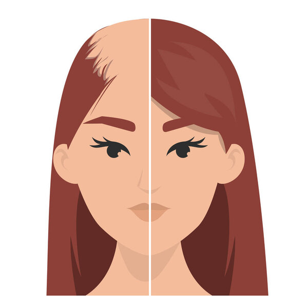 Hait transplantation before and after vector isolated. Alopecia treatment, forget about baldness. Hairless woman.