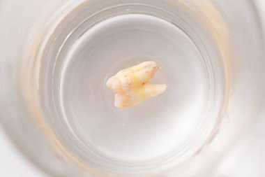 Bir bardak suda diş çürümesi