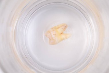 Bir bardak suda diş çürümesi