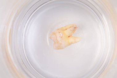 Bir bardak suda diş çürümesi