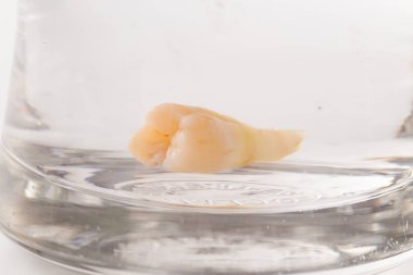 Bir bardak suda diş çürümesi