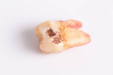 Beyaz arka plan üzerinde dişler üzerinde Çürükler