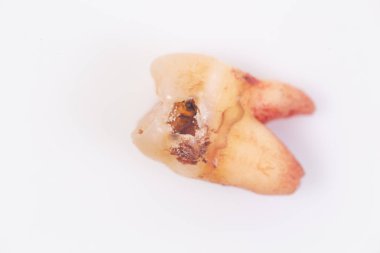 Beyaz arka plan üzerinde dişler üzerinde Çürükler