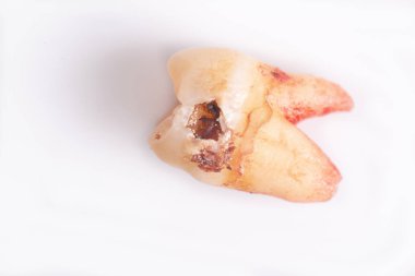 Beyaz arka plan üzerinde dişler üzerinde Çürükler