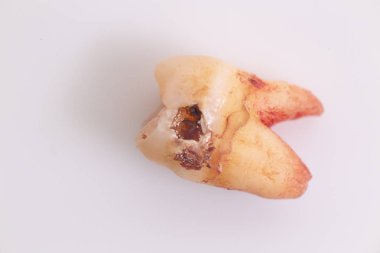 Beyaz arka plan üzerinde dişler üzerinde Çürükler