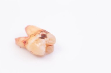 Beyaz arka plan üzerinde dişler üzerinde Çürükler