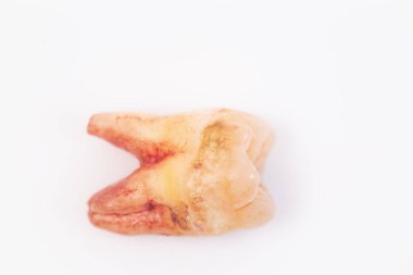 Beyaz arka plan üzerinde dişler üzerinde Çürükler