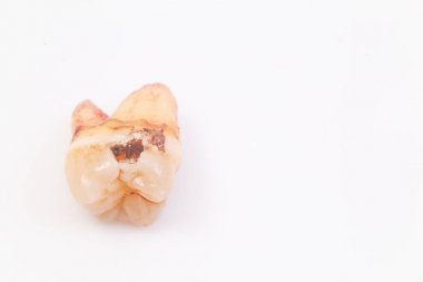 Beyaz arka plan üzerinde dişler üzerinde Çürükler