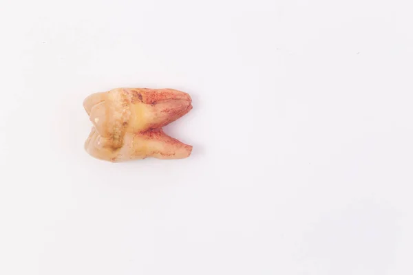 Caries Los Dientes Sobre Fondo Blanco — Foto de Stock