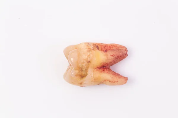 Beyaz Arka Plan Üzerinde Dişler Üzerinde Çürükler — Stok fotoğraf