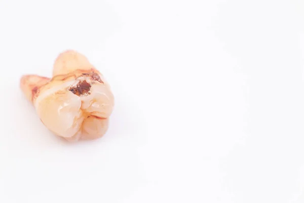 白い背景の歯の齲ア — ストック写真