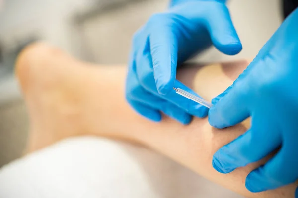 Hands of physiotherapist doing a dry needling — Stock Photo, Image