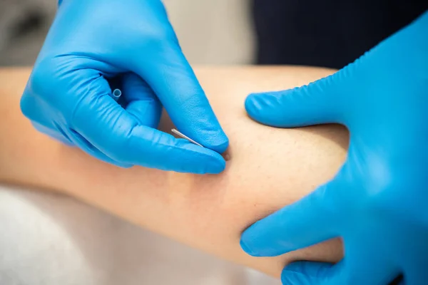 Hands of physiotherapist doing a dry needling — Stock Photo, Image