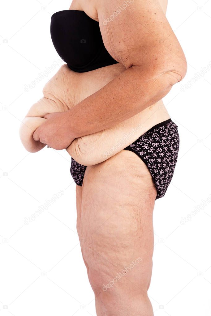 Middle aged woman with saggy skin after extreme weight loss