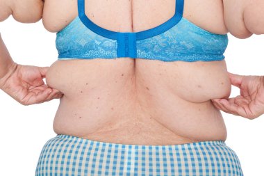 Orta aşırı kilo kaybını takiben aşırı kol cildin sarkmasını kadınla yaşlı. Brachioplasty, panniculectomy, karın germe ve mumya makeover önce. Exces cilt tutan arkadan görünüm.