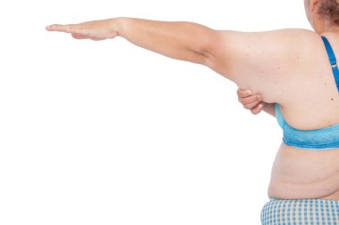 Orta aşırı kilo kaybını takiben aşırı kol cildin sarkmasını kadınla yaşlı. Brachioplasty, panniculectomy, karın germe ve mumya makeover önce. Aşırı cilt tutan arkadan görünüm tam sol kol.