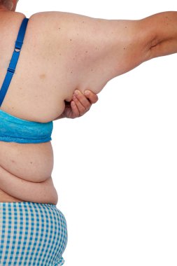 Orta bebekler ve aşırı kilo kaybı sonra cildin sarkmasını kadınla yaşlı. bönce brachioplasty, panniculectomy, karın germe ve mumya makyaj. Arkadan görünüm bölümü sağ kol fazla derinin holding.