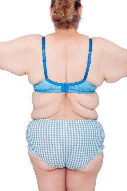Orta aşırı kilo kaybını takiben aşırı kol cildin sarkmasını kadınla yaşlı. Brachioplasty, panniculectomy, karın germe ve mumya makeover önce. Arkadan görünüm kollarını bingo kanatları ile.