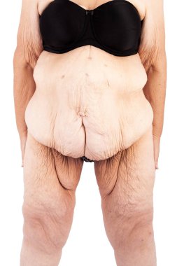 Middle aged woman with sagging skin after babies and extreme weight loss. Inspiration for poster and meme, before brachioplasty, panniculectomy, abdominoplasty and mummy makeover in Australia. clipart