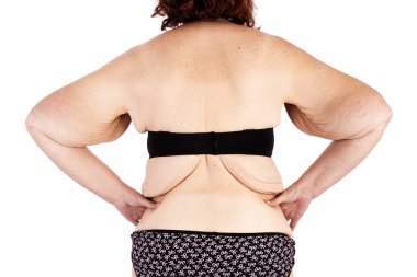 Orta bebekler ve aşırı kilo kaybı sonra cildin sarkmasını kadınla yaşlı. Poster ve meme, daha önce brachioplasty, panniculectomy, karın germe ve mumya makyaj Avustralya için ilham kaynağı.