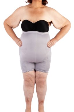 Orta bebekler ve aşırı kilo kaybı sonra cildin sarkmasını kadınla yaşlı. Poster ve meme, daha önce brachioplasty, panniculectomy, karın germe ve mumya makyaj Avustralya için ilham kaynağı.