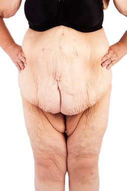 Orta bebekler ve aşırı kilo kaybı sonra cildin sarkmasını kadınla yaşlı. Poster ve meme, daha önce brachioplasty, panniculectomy, karın germe ve mumya makyaj Avustralya için ilham kaynağı.