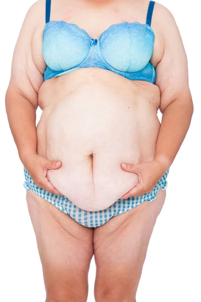 Middle Aged Woman Sagging Skin Babies Extreme Weight Loss Inspiration — Stock Photo, Image