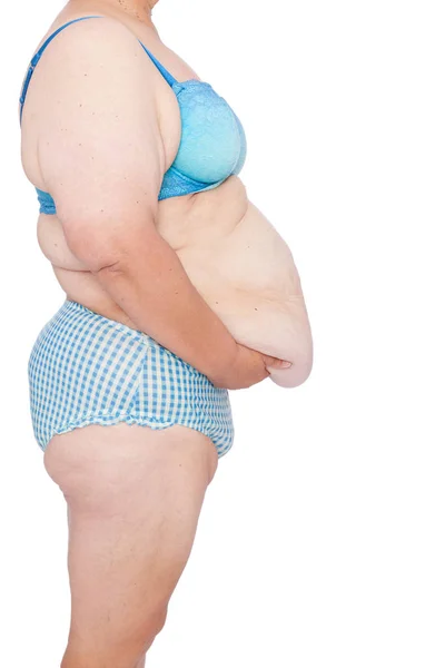 中年赤ちゃんや極端な体重減少後の余分な皮膚を持つ女性 Brachioplasty 脂肪層切除 腹部およびミイラの変身 横から見た図 右腹の余分な皮膚を保持しているに直面しています — ストック写真