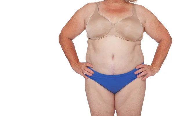 Brachioplasty 脂肪層切除 腹部とミイラの変身後の体重増加と更年期の女性 全身正面手腰 コピー領域を 変身のインスピレーションは 色あせた傷跡 — ストック写真