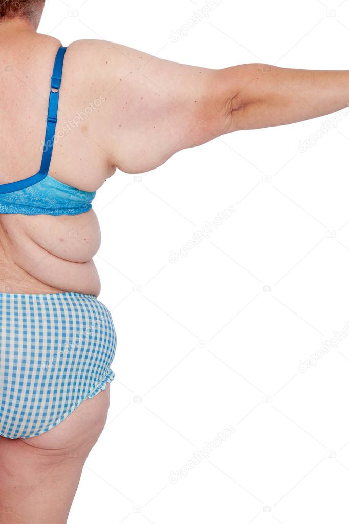 Middle aged woman with sagging excess arm skin after extreme weight loss. Before brachioplasty, panniculectomy, abdominoplasty and mummy makeover. Back view part right arm.