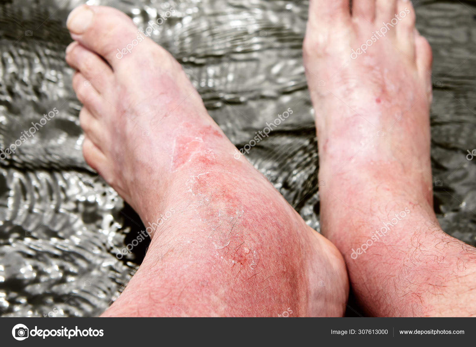 Sunburn On The Skin Of The Foot And Ankle Stock Photo By C Grigvovan Sunburn On The Skin Of The Foot And Ankle Stock Photo By C Grigvovan