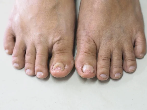 Svamp Nagelinfektion Onychomycosis Tinea Unguium — Stockfoto