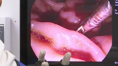 Doktorlar karın cerrahisi gerçekleştirmek için tıbbi aletler ve video kameralar kullanın .
