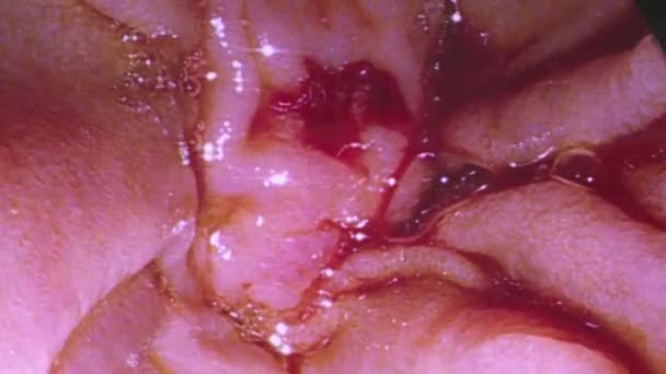 Médicos usam instrumentos médicos e câmeras de vídeo para realizar cirurgia abdominal  . — Vídeo de Stock