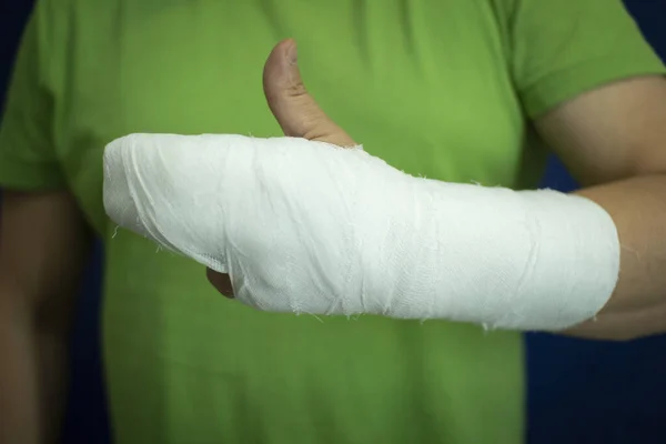 Un hombre con un yeso en el brazo. Mano de hombre en vendajes después de la cirugía . — Foto de Stock