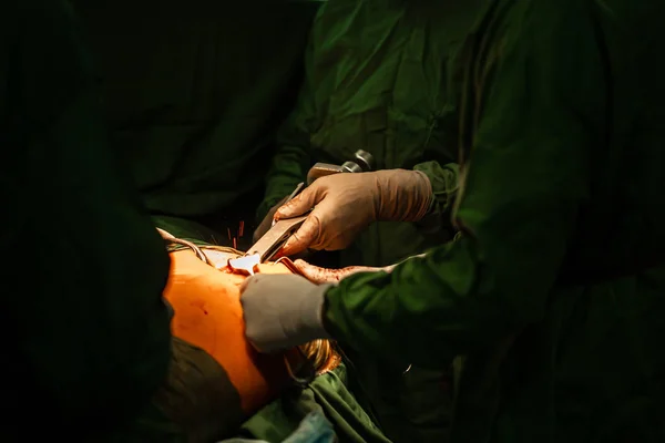 Ασθενείς και ομαδική εργασία κατά τη διάρκεια χειρουργικής αντικατάστασης ισχίου στο χειρουργείο — Φωτογραφία Αρχείου