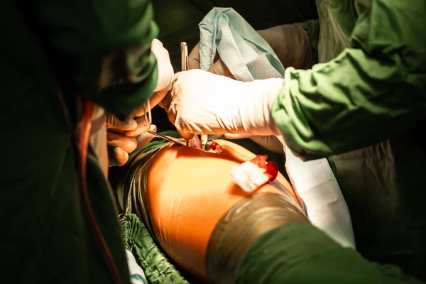Διαδικασία αντικατάστασης ισχίου. Ομάδα χειρουργών στο χειρουργείο με χειρουργικό εξοπλισμό. Ιατρικό υπόβαθρο — Φωτογραφία Αρχείου