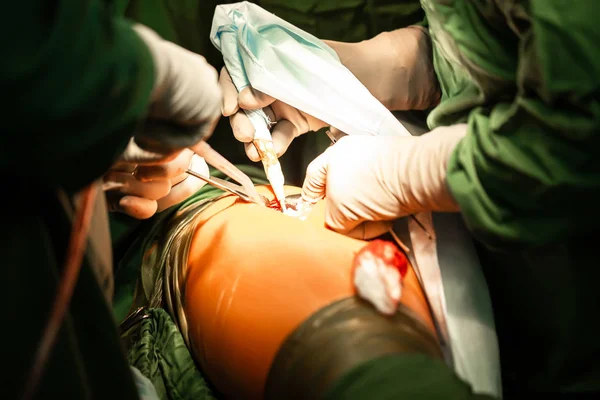 Artroplastia do quadril com fixação de componentes de cimento. Equipe de cirurgiões faz uma dissecção no centro hospitalar — Fotografia de Stock