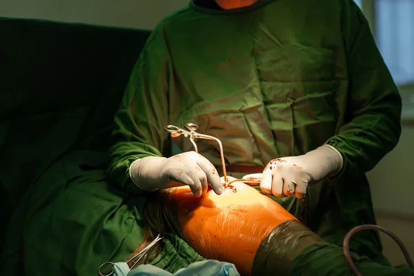Processen för traumaoperation. total höftledsplastik med cementfixering av komponenter. Läkare som hjälper kirurgiska patienter — Stockfoto
