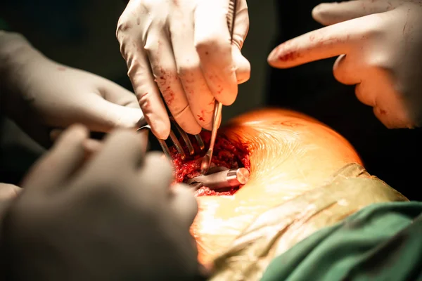 Heupvervangende operatie aan de gang, open holte met weke delen oprolmechanismen en schuifgereedschap. Ouderdomsproblemen, senioren, gemeenschappelijke chirurgie, moderne orthopedische problemen, medische professionals concept — Stockfoto