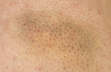 İnsan bacağında farklı renklerde büyük çürükler var.