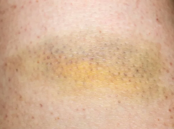 Large Bruise Hematoma Humans Leg Skin Different Colors — Stock Photo, Image