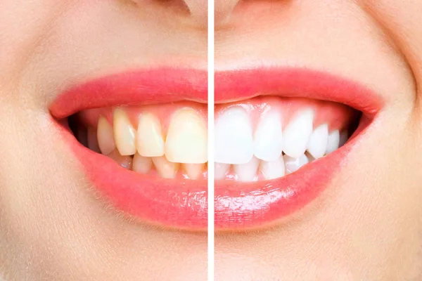 Kadın önce ve sonra beyazlatma dişler. Beyaz arka plan üzerinde Stok Resim
