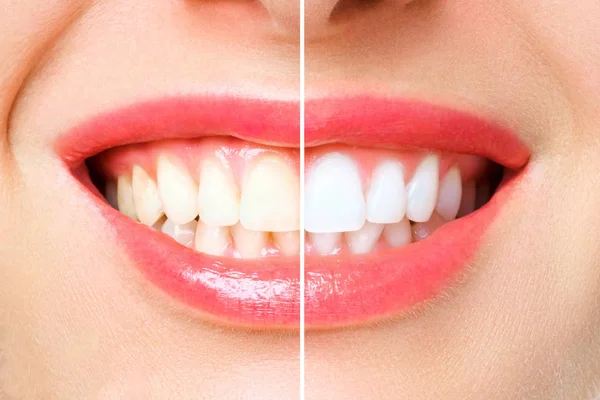 Žena zubů před a po bělení. nad bílým pozadím — Stock fotografie